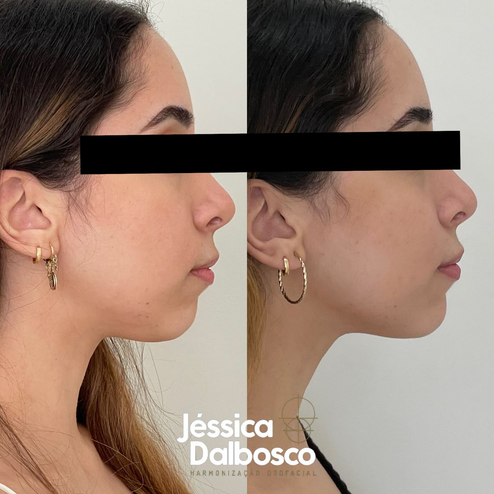 Preenchimento queixo e lábios