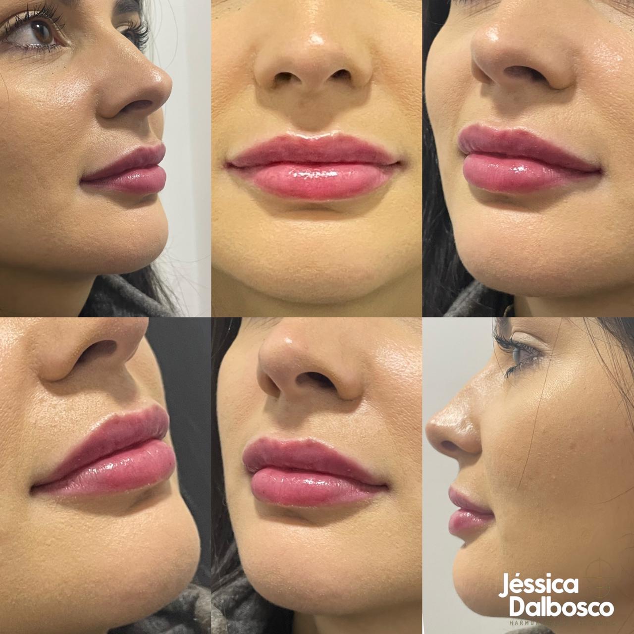 Preenchimento labial