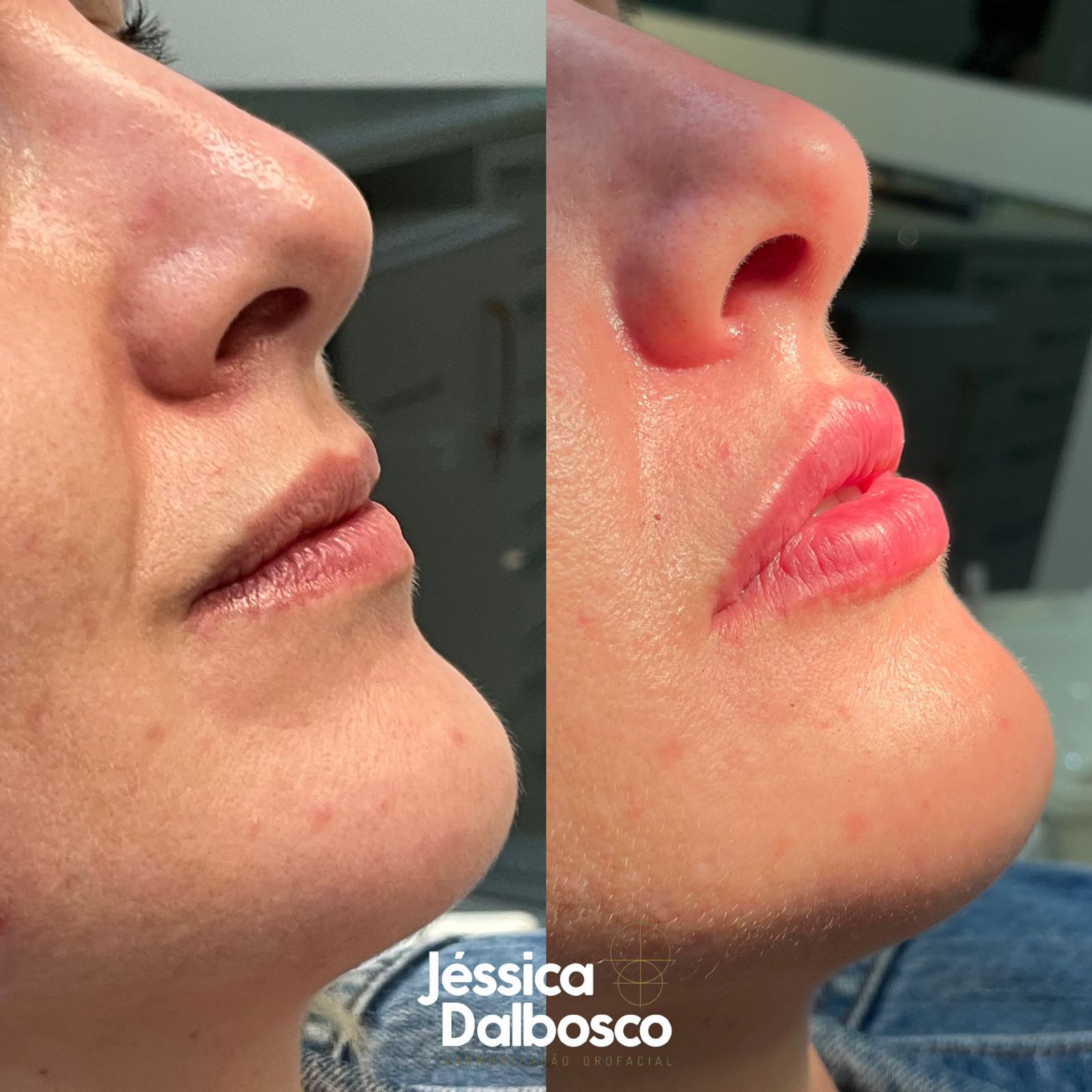 Preenchimento labial