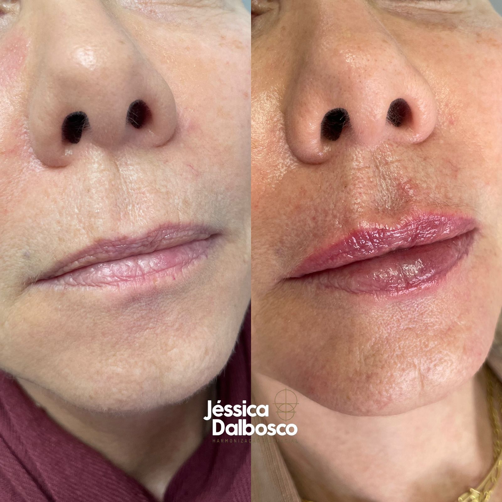 Preenchimento FULL FACE